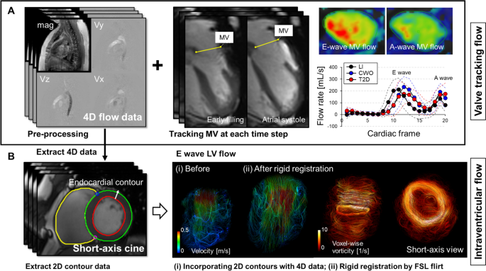 Figure 1 from Park et al., showing mitral valve tracking and left ventricular flow and vorticity analysis using 4D flow CMR.