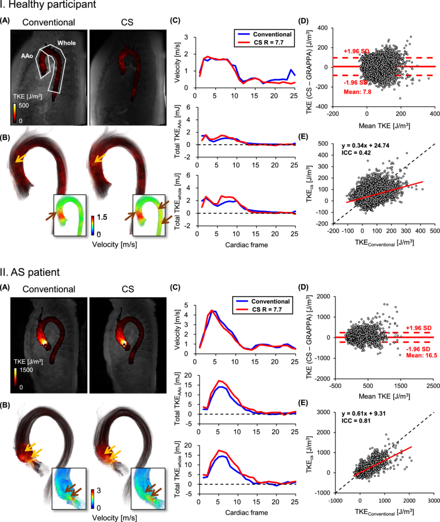 Full Figure 1 comparing conventional and compressed sensing 4D flow MRI TKE maps, streamlines, and quantitative analyses in a healthy participant and an aortic stenosis patient