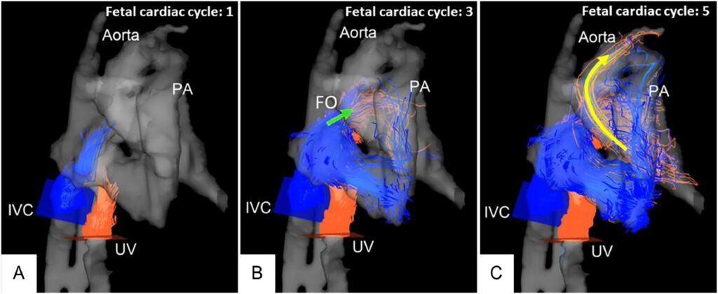 Fetal 4D flow MRI pathlines crossing the foramen ovale and continuing toward the aorta