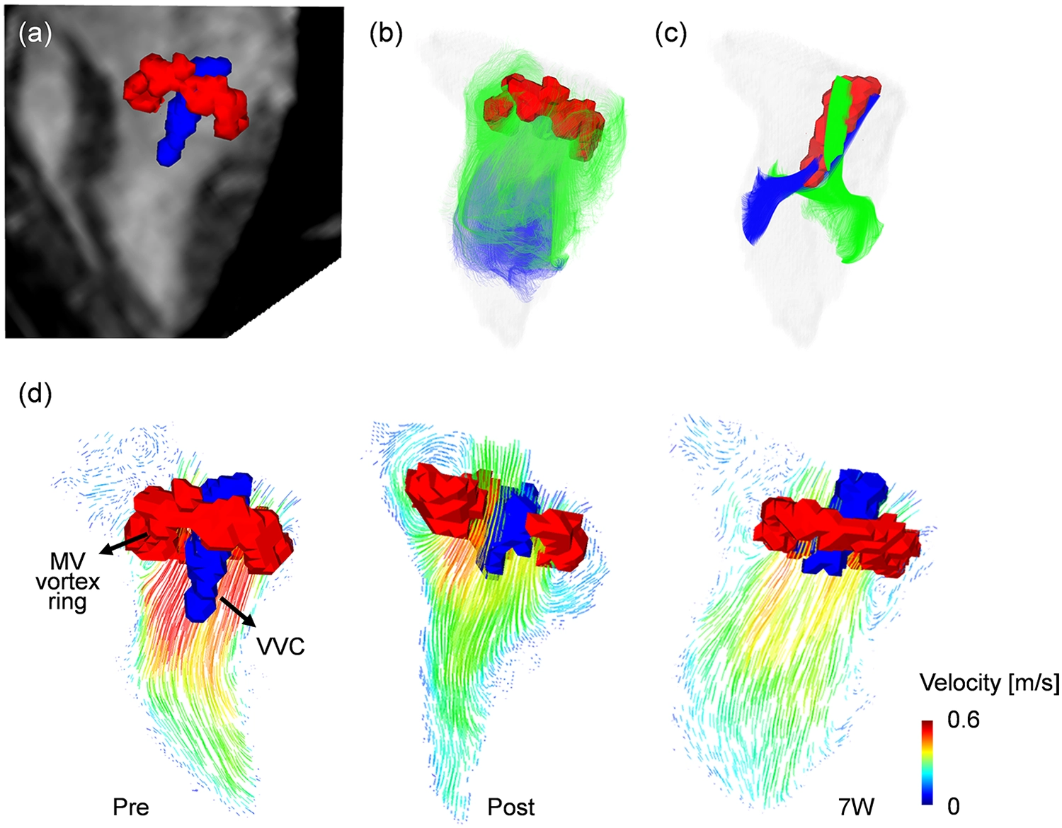 4D flow MRI vortex cores, particle traces, and velocity vectors in a porcine myocardial infarction model