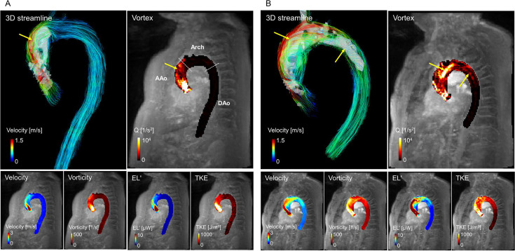 Baseline 4D flow MRI visualizations in patients who did and did not subsequently undergo aortic valve replacement